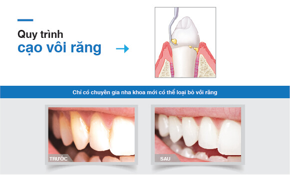 Cạo vôi răng tại Nha khoa Westcoast