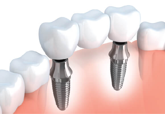 Nhược điểm của implant được khắc phục khi thực hiện tại Westcoast