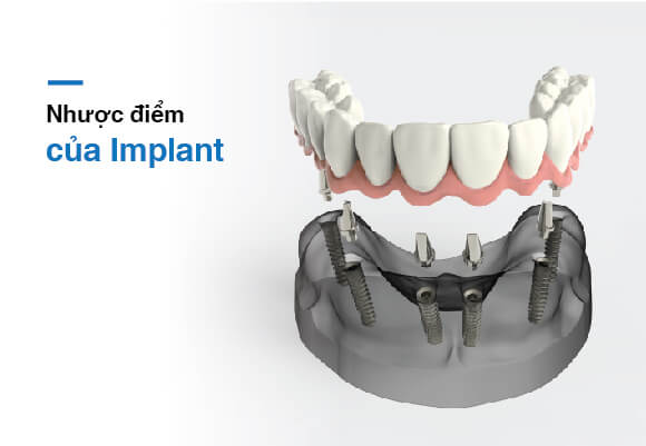 Tại sao trồng răng implant thất bại và làm thế nào để tránh?