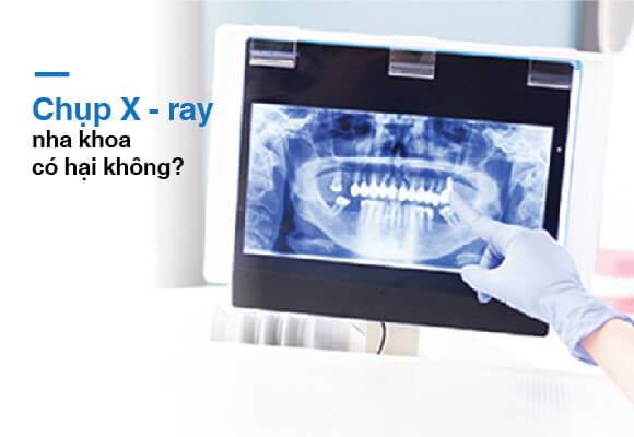 X-quang có tác hại đến sức khỏe không?