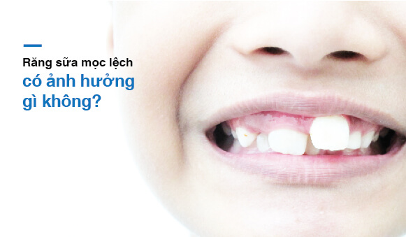 Răng sữa mọc lệch có gây ảnh hưởng gì đến trẻ không?