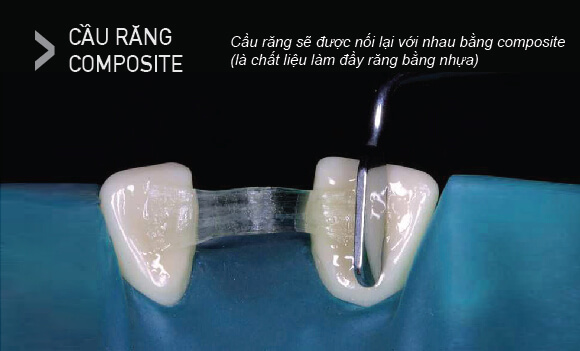 Loại Cầu răng Composite 
