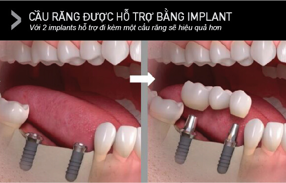 Loại Cầu răng được hỗ trợ bằng implant - Implant Supported Bridges
