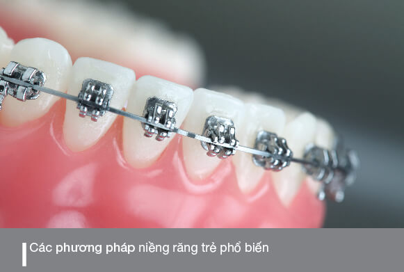 các phương pháp niềng răng cho trẻ phổ biến