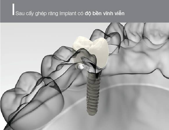 sau khi được cấy ghép răng implant có độ bền vĩnh viễn