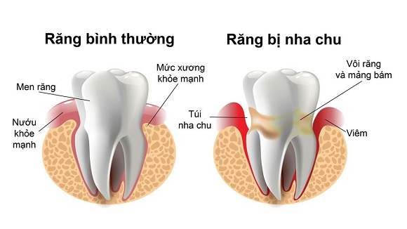 mất răng cho bệnh nha chu nha khoa westcoast