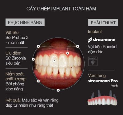 cay-ghep-Implant-toan-ham