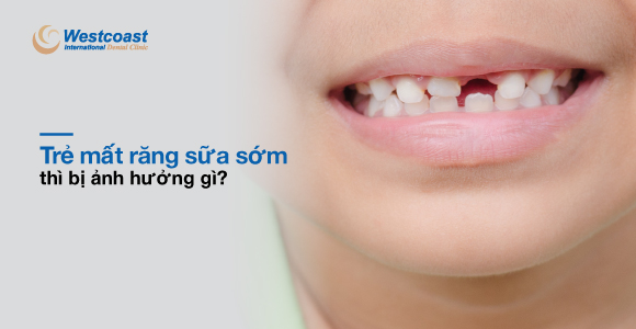 Nhổ răng sữa sớm có thể gây khó khăn trong việc phát âm của trẻ như thế nào?
