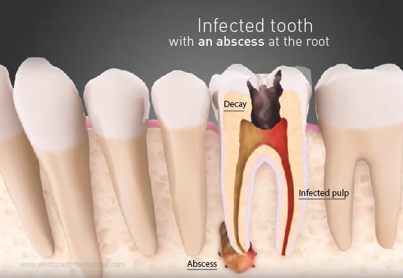 Phương pháp chữa trị u chân răng hiệu quả nhất là gì?
