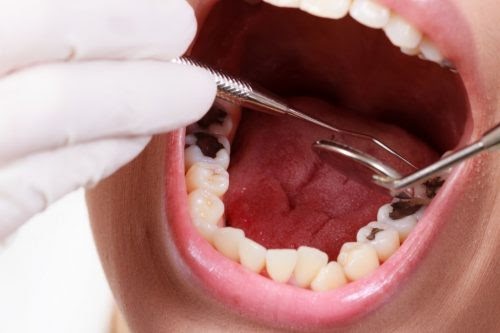 Sâu răng ăn sâu vào tủy răng cần điều trị bằng phương pháp lấy tủy