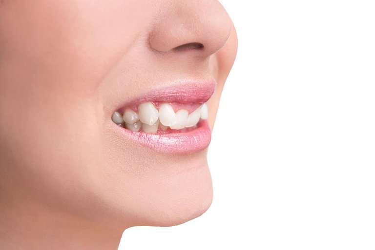 Có phương pháp thông dụng nào để sửa chữa răng khểnh không cần can thiệp phẫu thuật?
