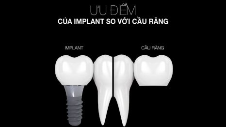 ưu điểm implant so với cầu răng nha khoa westcoast