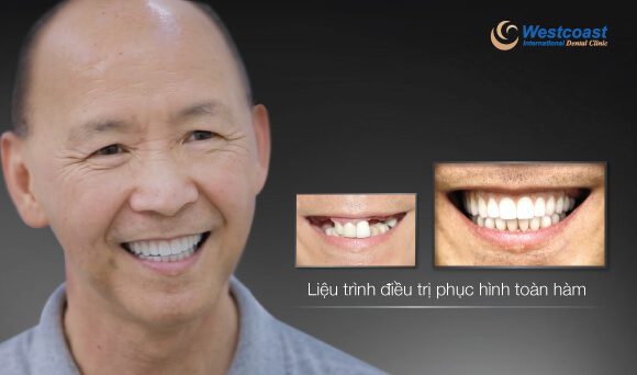 phục hình răng toàn hàm với implant - nha khoa westcoast