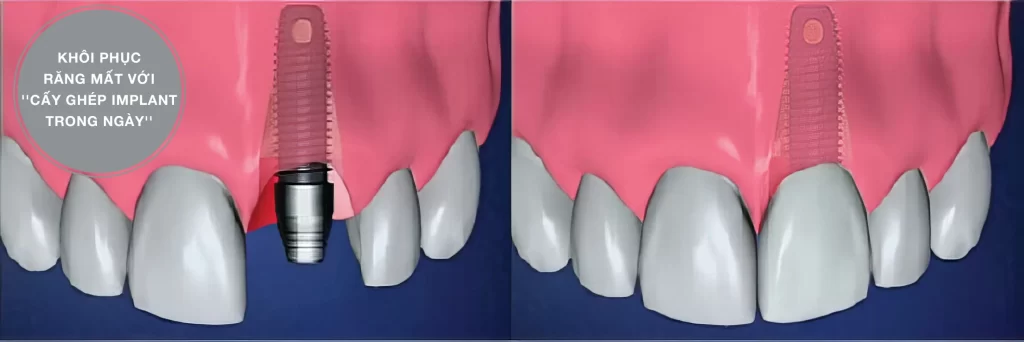 CẤY GHÉP RĂNG IMPLANT TRONG NGÀY