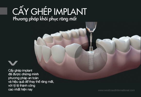 Cấy Ghép Implant Là Gì?