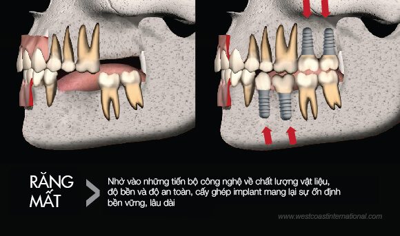 Ưu Điểm Của Cấy Ghép Răng Implant