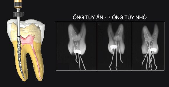 Bỏ sót hoặc không thể tiếp cận một ống tủy ẩn