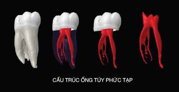 Cấu trúc ống tủy quá phức tạp