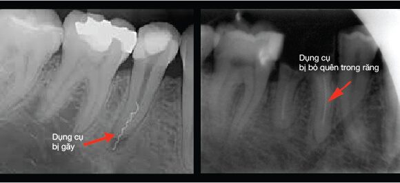 Dụng cụ bị gãy trong ống tủy