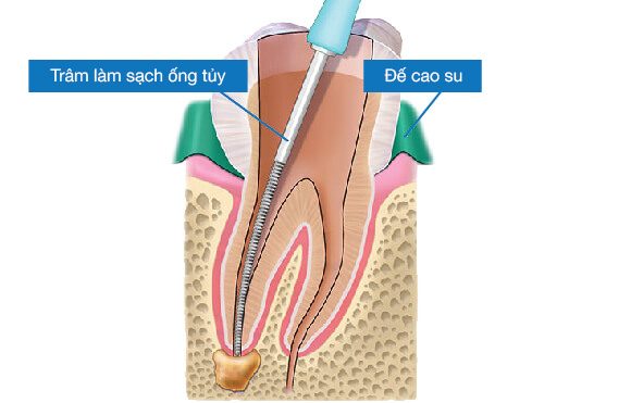 Không làm sạch và khử trùng ống tủy