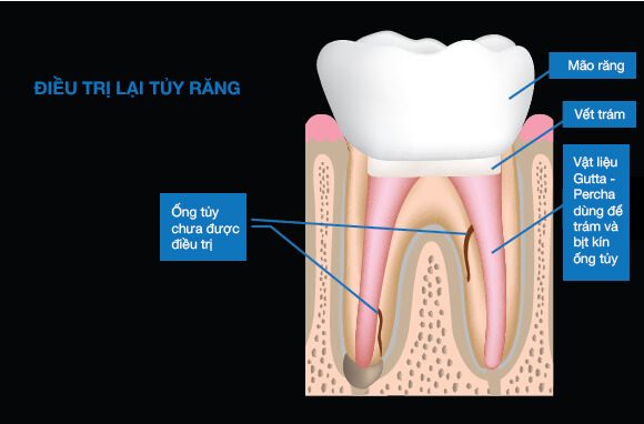 Rò rỉ vi khuẩn vào hệ thống ống tủy từ lớp trám phục hồi