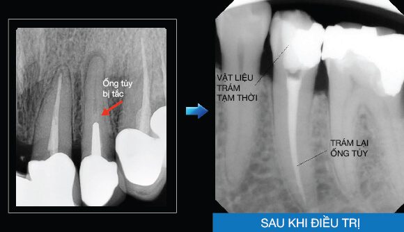 Tắc nghẽn ống tủy