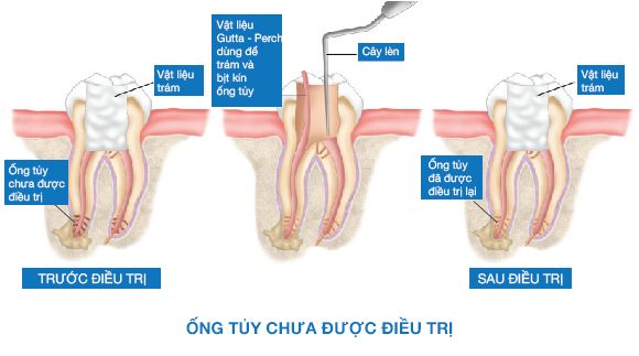 Trám bít ống tủy không kín