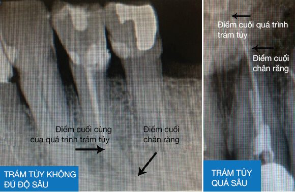 Ước tính sai độ dài của ống tủy