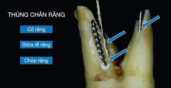 rách ống tủy hoặc thủng sàn buồng tủy